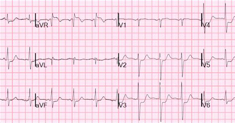 Dr Smiths Ecg Blog Guess The Culprit With St Elevation In Posterior