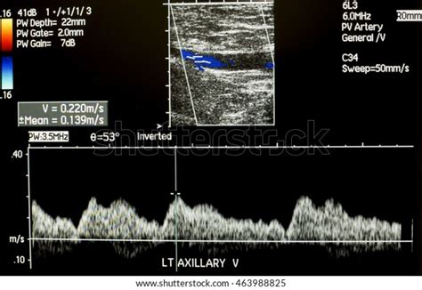 Doppler Ultrasound Left Axillary Vein Wave Stock Photo 463988825