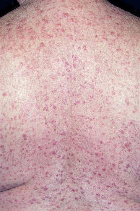 Eczema On The Back Photograph By Dr P Marazziscience Photo Library