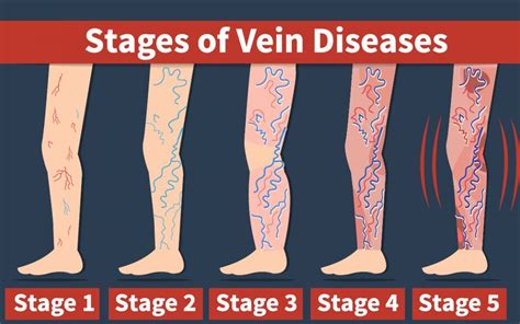 Venous Disease Millions Suffer But Treatments Can Be Life Changing