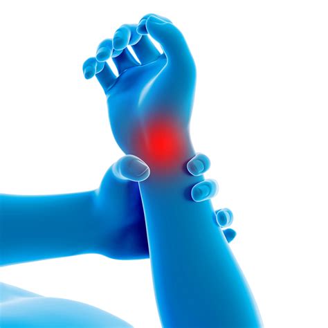 Osteoarthritis In The Wrist Cause Symptoms Diagnosis And Treatment