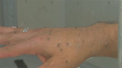 Mosquito Bites Could Lead To ‘skeeter Syndrome