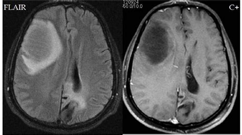 Figure 1 From Differential Diagnosis Of Ring Enhancing Lesions In