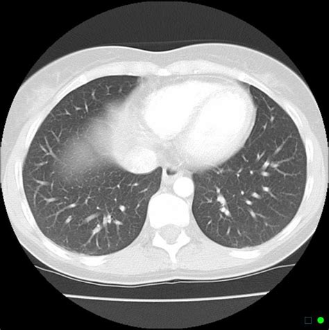 Normal Chest Ct Lung Window Radiology Case