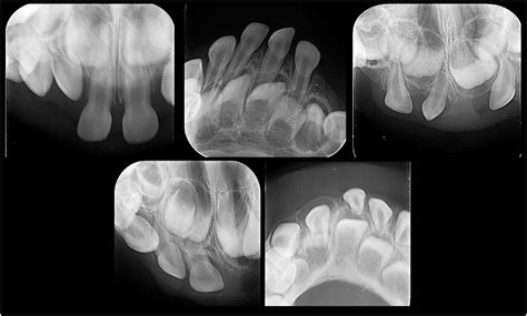 Scielo Brasil Radiographic Evaluation Of Dental Anomalies In