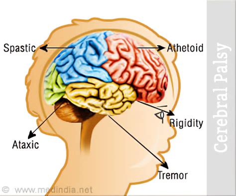 Cerebral palsy's considered a neurodevelopmental disease, meaning that something happens to an area of the brain during its initial development, which is an extremely sensitive period. Cerebral Palsy: Causes Symptoms Treatment Types Therapy ...