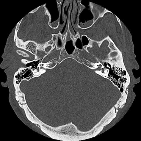 Normal Petrous Temporal Bone CT Radiology Case Radiopaedia Org