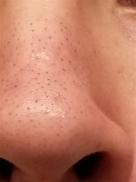 I suffer from blackheads litterally everywhere on my nose, how to get