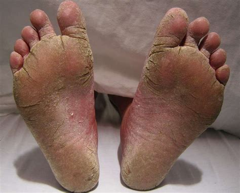 The Hard Facts About Foot Calluses Dermmedica