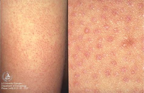 Bumpy White Spots On Skin Dorothee Padraig South West Skin Health Care