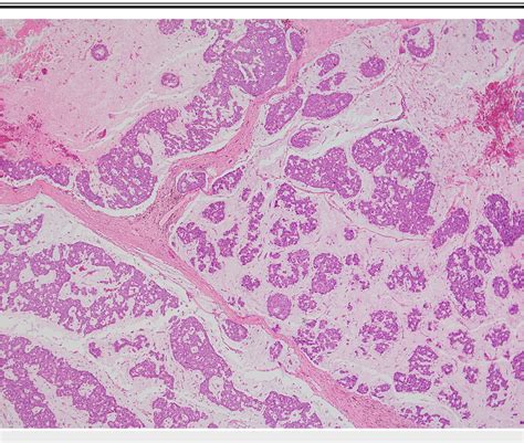 Pdf A Case Of Eccrine Mucinous Carcinoma Involving Scalp Semantic