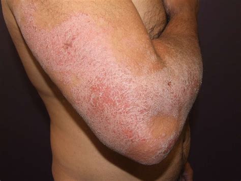 How Atopic Dermatitis Is Diagnosed
