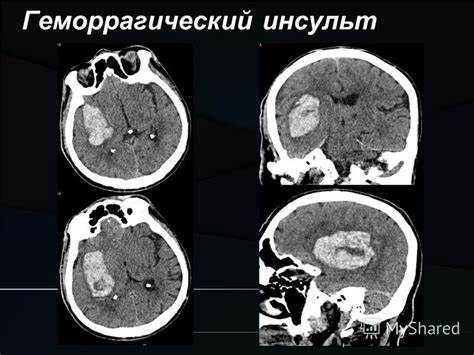 Геморрагический инсульт диета Геморрагический инсульт и гепатит - фото презентация Геморрагический инсульт и гепатит - фото презентация Геморрагический инсульт диета