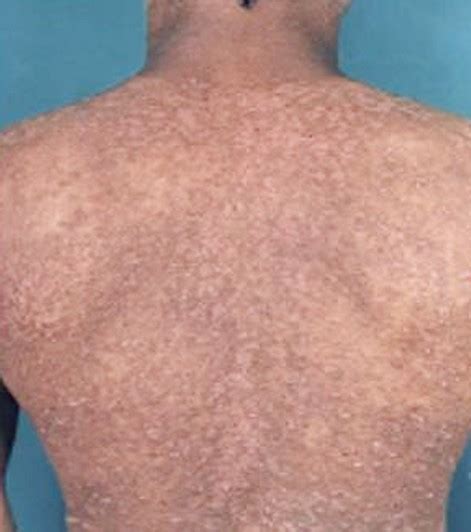 Maculopapular Rash Pictures Causes Treatment Diagnosis 2018
