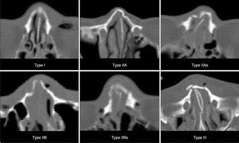The nasal bones are ossified intramembranously via the cartilaginous nasal capsule. Classification of nasal bone fracture. Each types ...