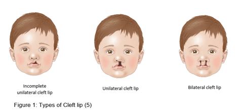 Cleft Lip And Palate In Neonates Safer Care Victoria