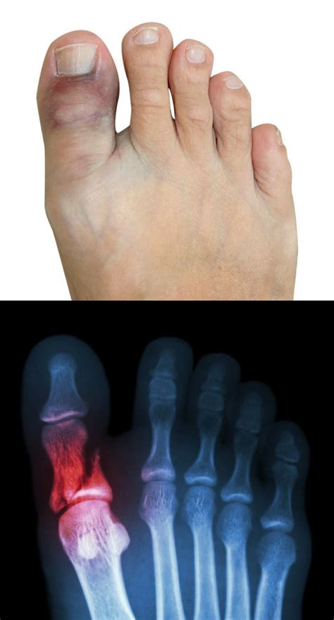 Sprained Big Toe Vs Broken Big Toe Causes Symptoms And How To Treat