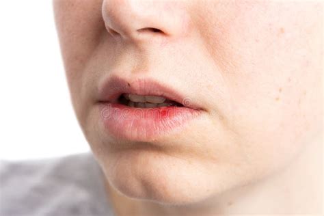 Pustule Ulceration Or Aphtae On Woman Lip Stock Image Image Of Mouth