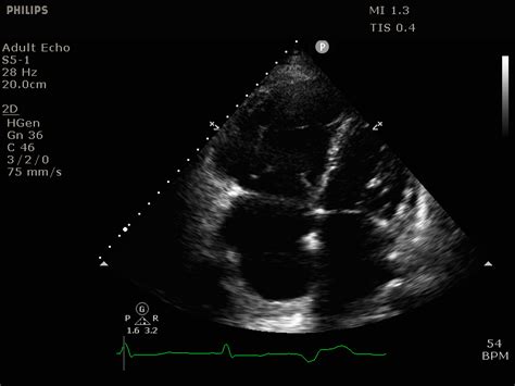Transthoracic Echocardiogram Apical 4 Chamber View Showing Massive