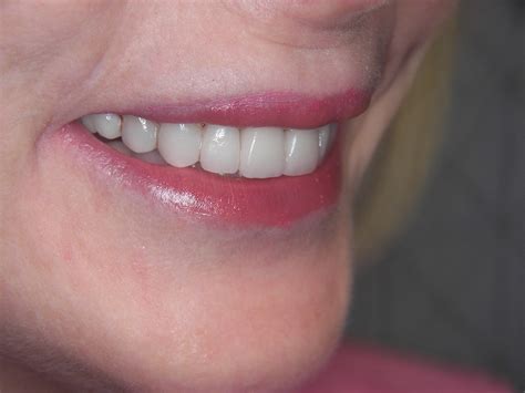 Kosdon will create temporary veneers to protect your prepared teeth and provide a preview of your new smile while your. Fleur de Lis Dental Care | Veneers & Dental Crowns Gallery