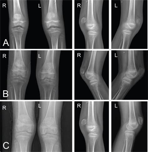 Bilateral Patella Sleeve Avulsions In An Otherwise Healthy Nine Year