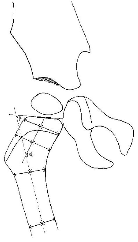 Diagram To Show The Method Of Measuring The Femoral Neck Shaft Angle
