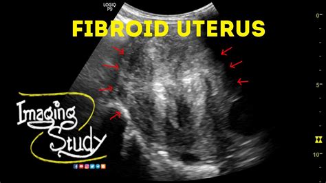 Fibroid Uterus Ultrasound Case 45 Youtube