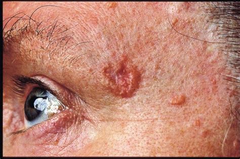 The only way to diagnose the condition is with a test called a biopsy. How to check your skin for skin cancer | Queensland Health
