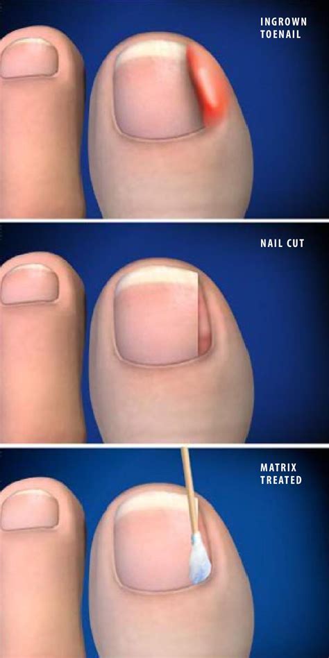 Partial Nail Avulsion Post Surgery - Nail Ftempo