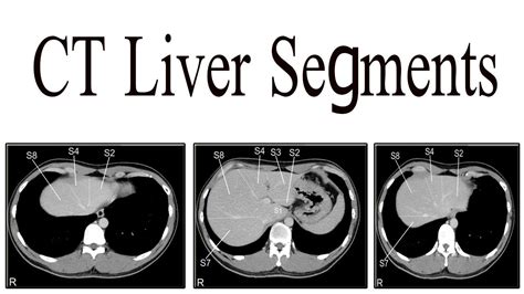 Ct Liver Segments Study Youtube