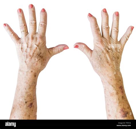 Elderly Woman Wrinkled Hand Palm W Clearly Visible Veins Reaching Out