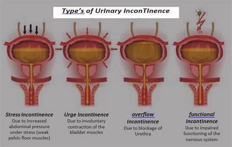 Doctors Network Urinary Incontinence Types And Its Tr