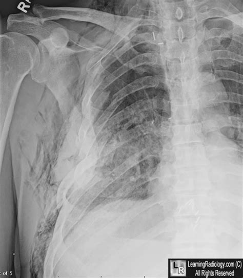 LearningRadiology Flail Chest Thoracic Trauma Fracture Ribs