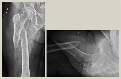 Subtrochanteric Fractures Of The Hip Orthopaedics And Trauma