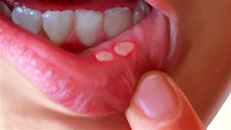 Mouth Sores Causes Symptoms Diagnosis Treatment And Prevention