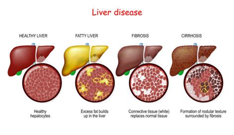 Liver Fibrosis Stock Photos Pictures And Royalty Free Images Istock