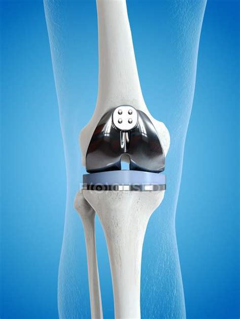 Illustration Of Knee Replacement Implant On Blue Background — Medical