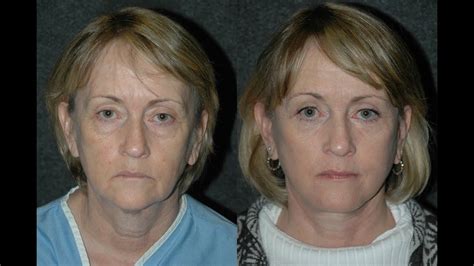 Facelift Surgery Before And After And Eyelid Lift On 60 Year Old Woman Nyc Best Facelift