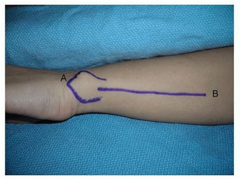 Anatomy And Surgical Approaches Of The Forearm Wrist And Hand