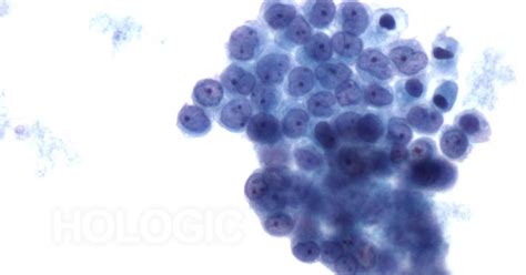 Check spelling or type a new query. Mesothelioma Pleural Effusion Cytology