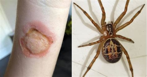 Mums Horror After Spider Bite Makes Daughters Skin Look Like Its