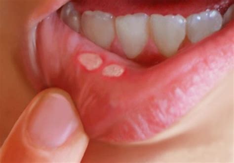 blisters in mouth symptoms treatment causes pictures