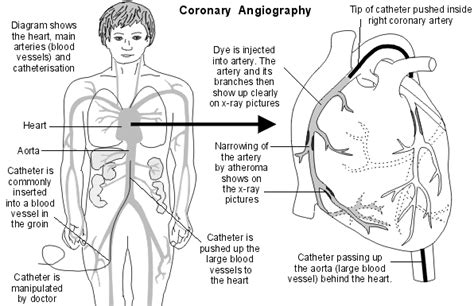 Coronary Angiogram Causes Symptoms Treatment Coronary