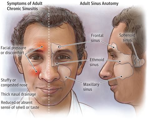 Adult Chronic Sinusitis Otolaryngology Jama Jama Network