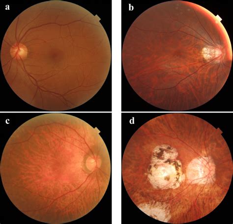 Typical Fundus Photographs Of Four Categories A Normal Or Mild