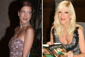 Tori Spelling Before And After Plastic Surgery