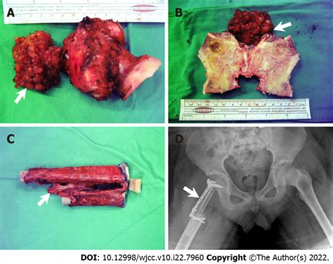 Resection With Limb Salvage In An Asian Male Adolescent With Ewings