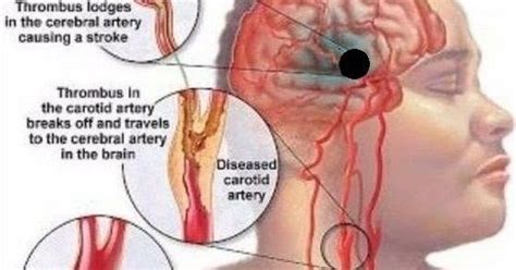 how to clean out plaque in arteries 3 ingredients mixture healhty and tips