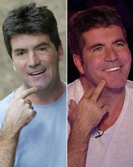 Simon Cowell Before And After Celebrity Smiles Botox Plastic Surgery