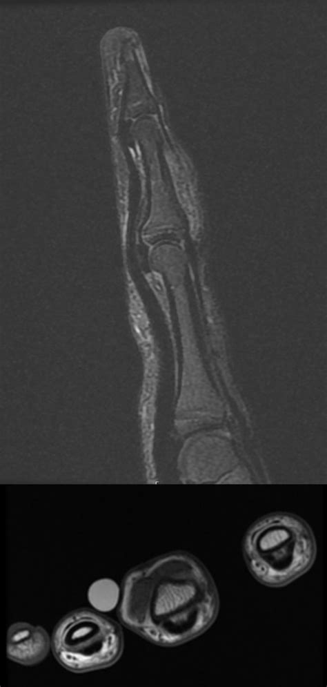 Recurrent Calcifying Aponeurotic Fibroma Of The Hand Managing A Rare